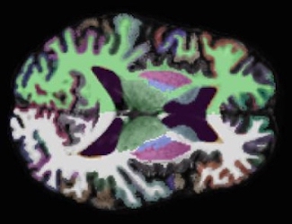mri of brain in color 